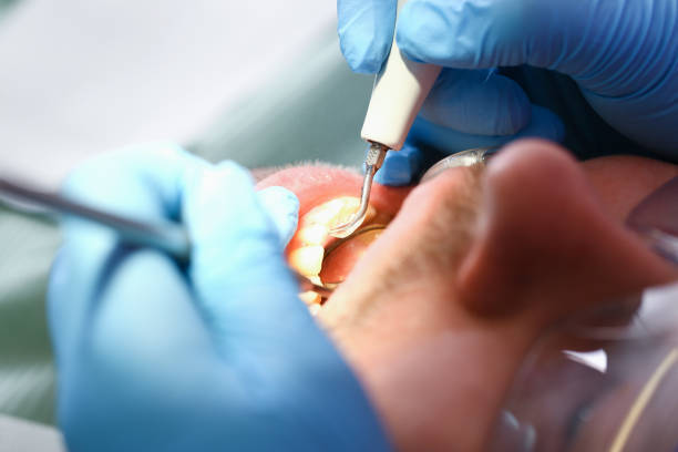 Best Emergency Tooth Extraction in Crowley, TX